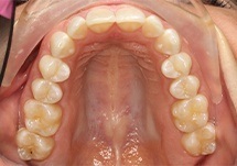 Upper Arch of Mouth